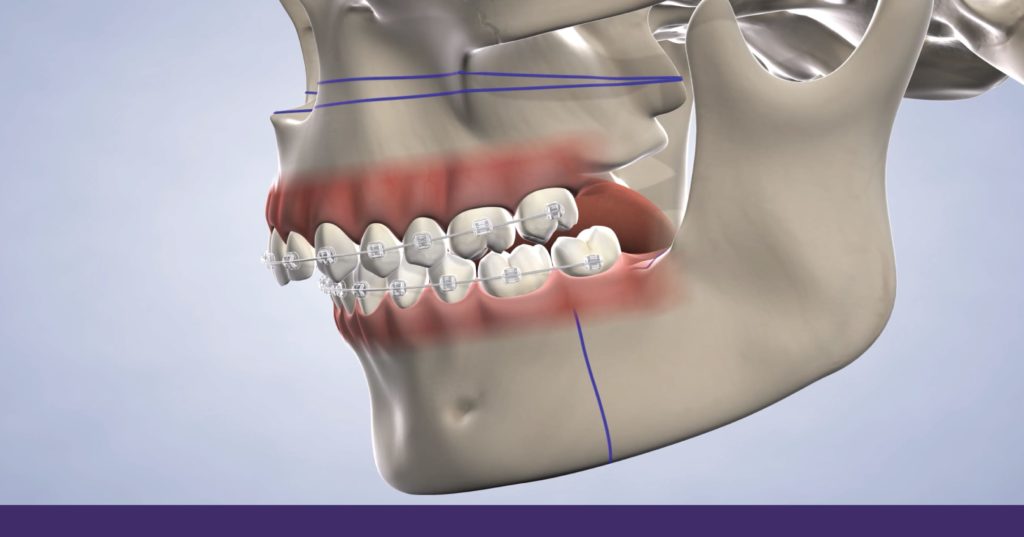 What is jaw surgery in Santa Fe, NM?